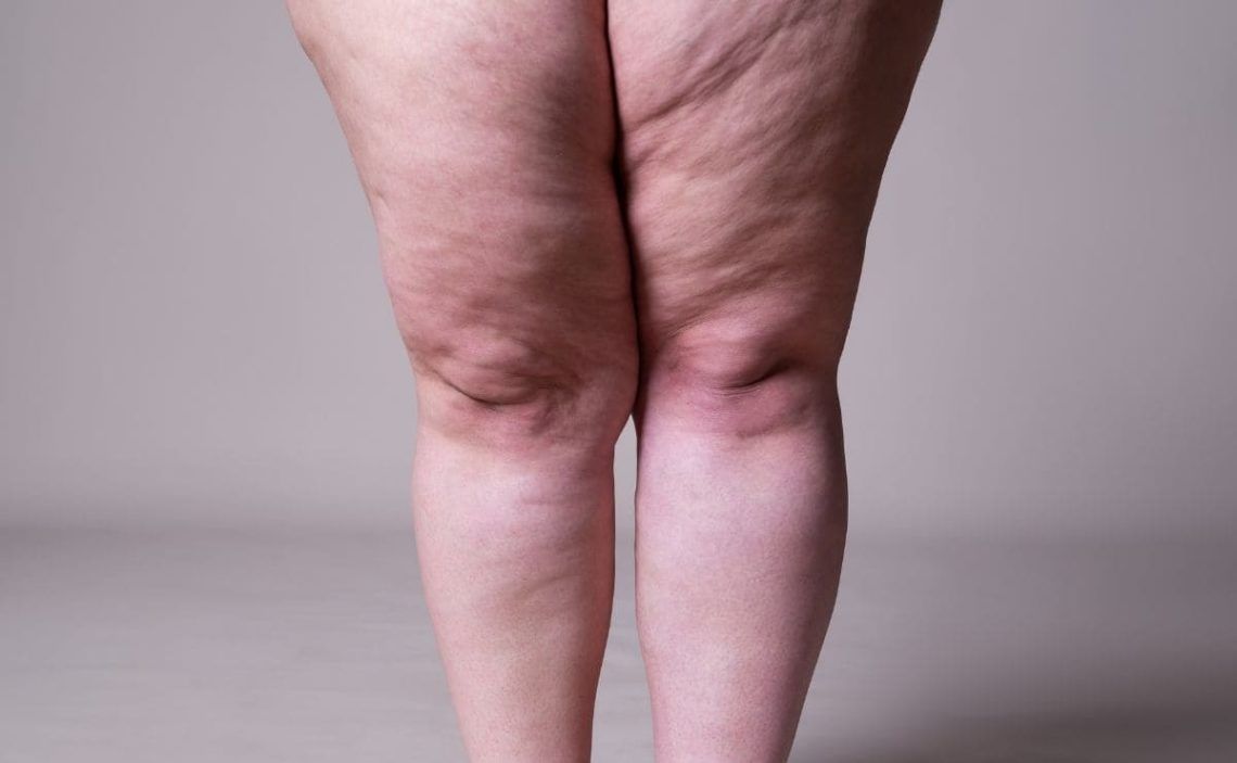 4 tips for slimming leg fat in a healthy way