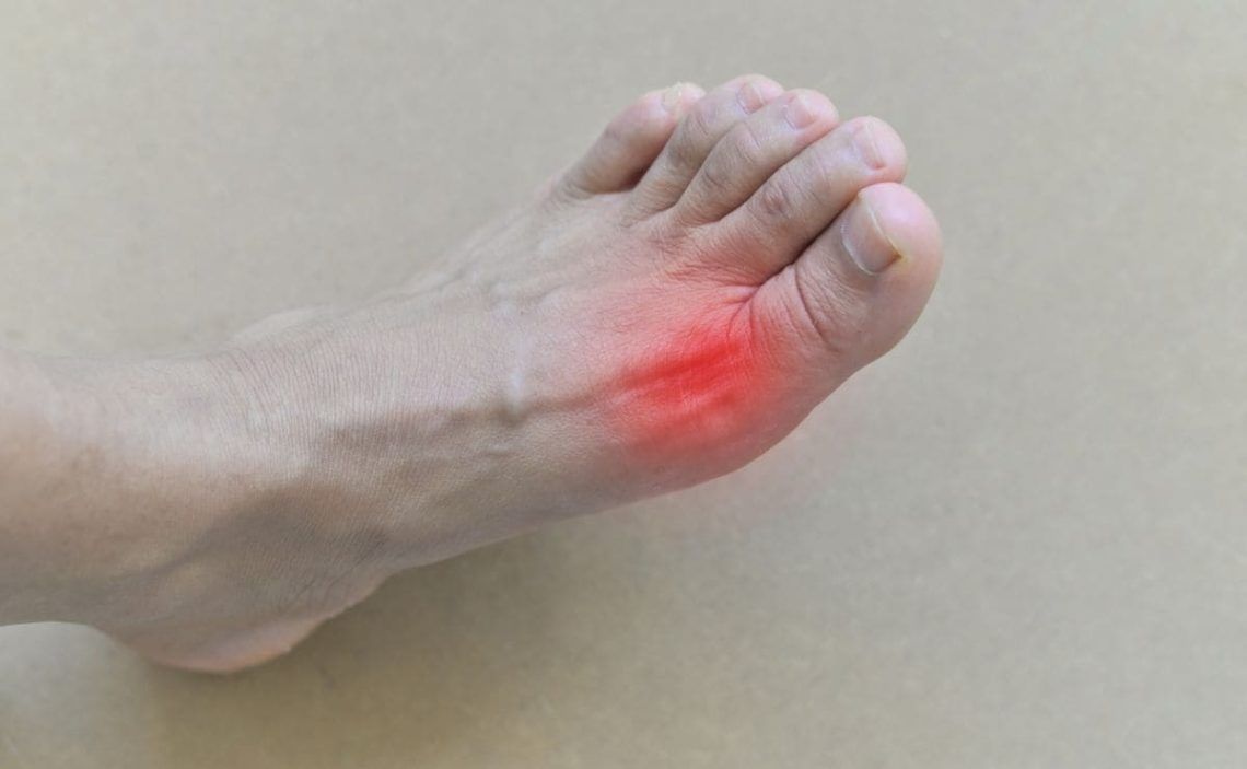 Gout is a chronic disease worsened by the accumulation of uric acid.