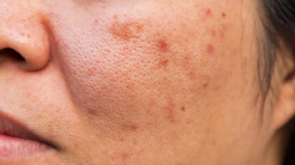 Cómo tratar la piel para evitar la aparición de acné