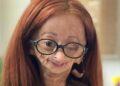 Adalia Rose Williams enfermedad Benjamin Button síndrome de Hutchinson-Gilford