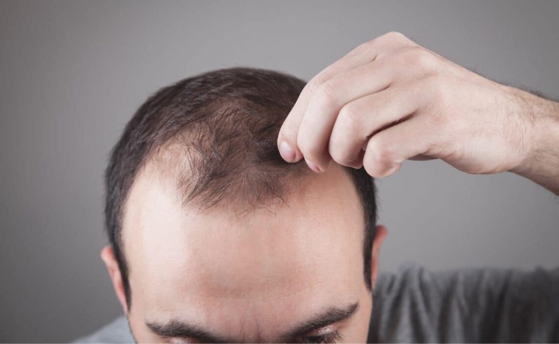 Alimentos caída del cabello