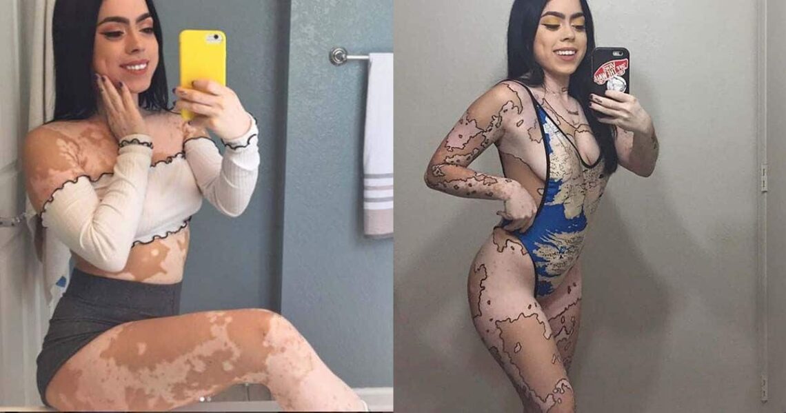 Antes y después de Ash Soto con vitíligo