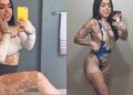 Antes y después de Ash Soto con vitíligo
