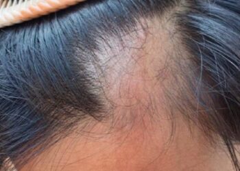 caída del cabello Coronavirus