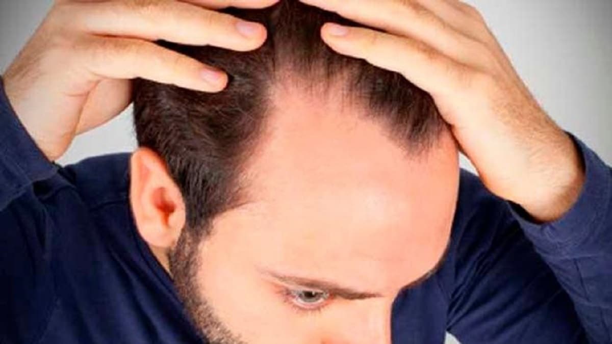 ¿Cuándo debe ser preocupante la caída del cabello?