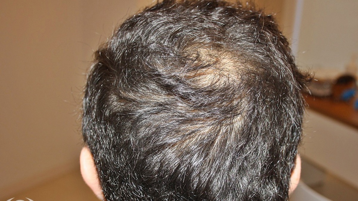 ¿Qué alimentos son buenos para evitar la caída del cabello?