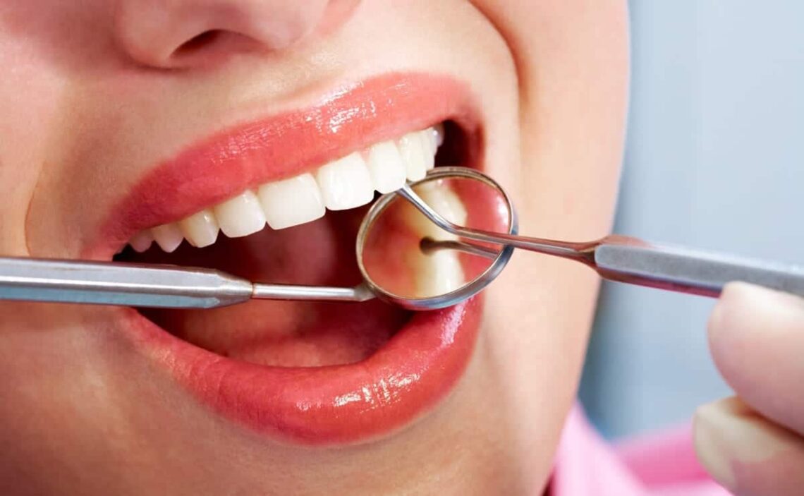 Caries - Revisión dental