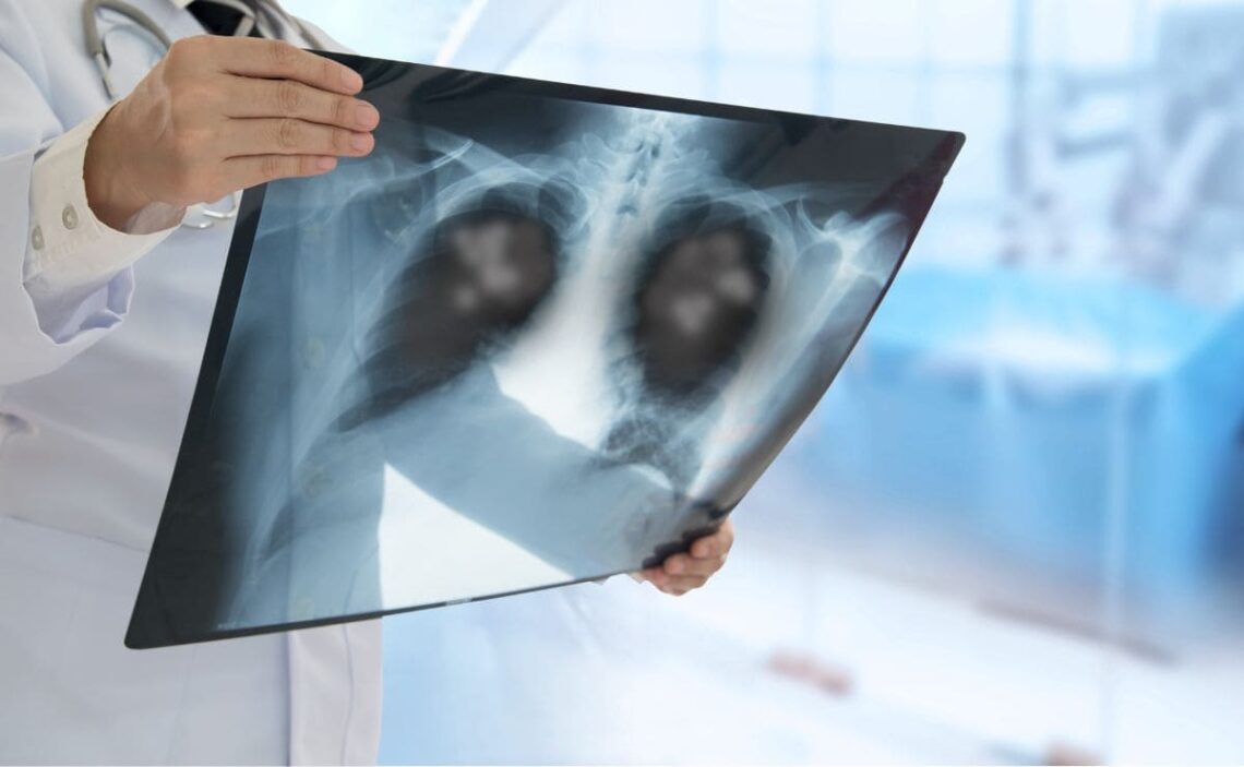 Incapacidad permanente por neumonía./ Foto de Canva