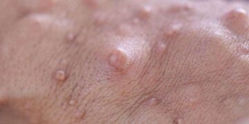 Neurofibromatosis tipo 2
