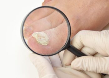 vitaminas, uñas débiles, hierro