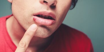 Remedio casero úlcera en la boca