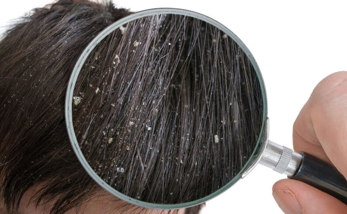 Remedios caseros para prevenir la caspa del cabello