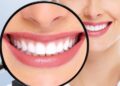 Remedios caseros sarro dental bicarbonato de sodio