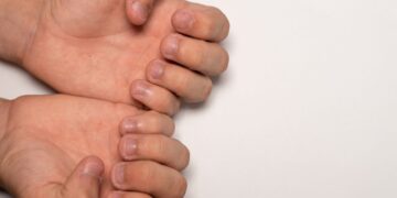 Bicarbonato, uñas, remedio casero