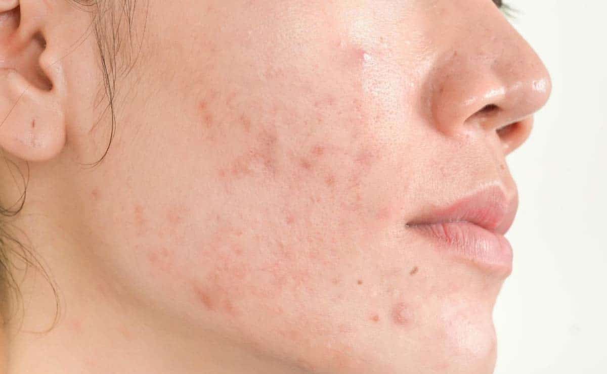 El llamado 'maskné' provocado por el uso de mascarillas