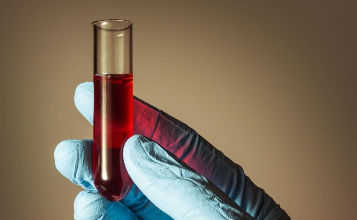 Análisis de sangre tempranos predicen la muerte y la discapacidad grave en lesión cerebral traumática