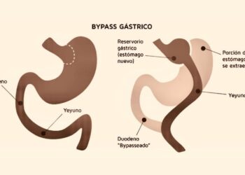 bypass gástrico
