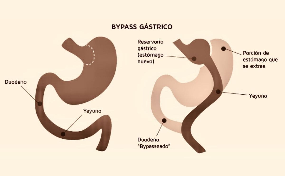 Estos son los beneficios del bypass gástrico para las personas con diabetes