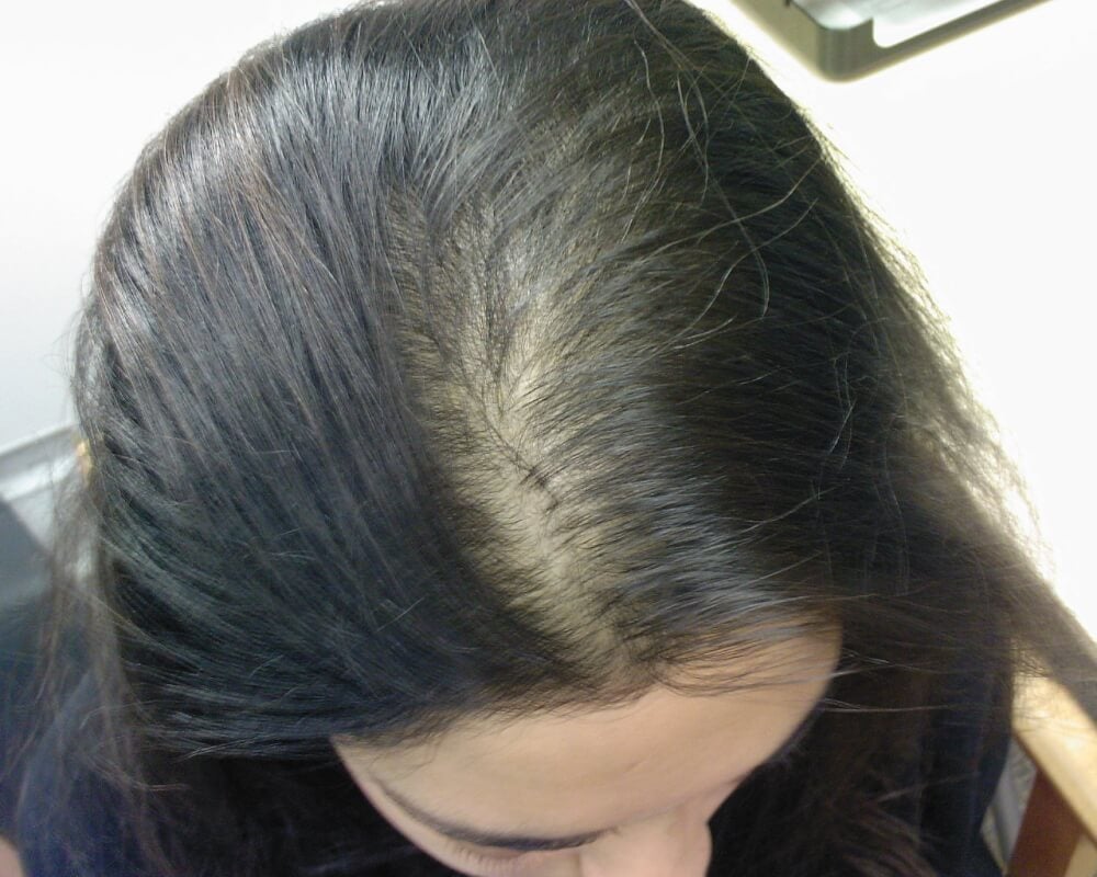 Las causas de la pérdida de cabello en las mujeres