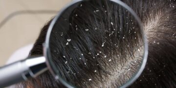 caspa remedio natural casero pelo suciedad pelo cabello