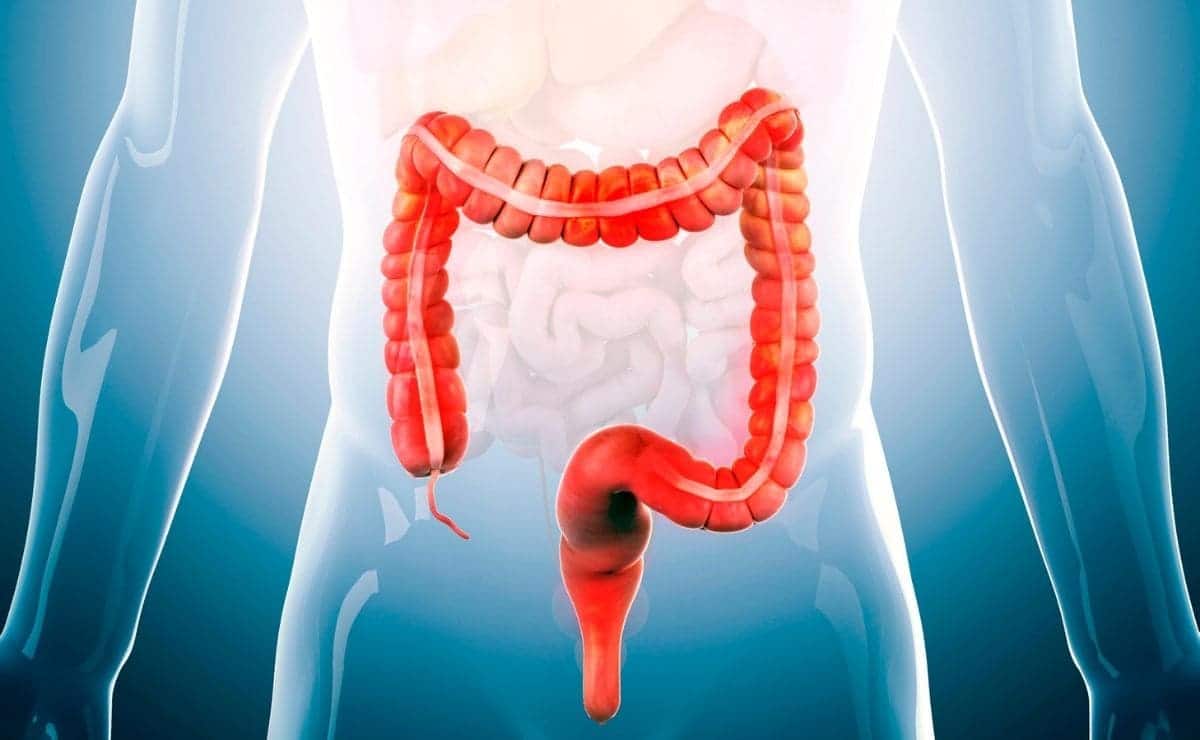 colon irritable dieta