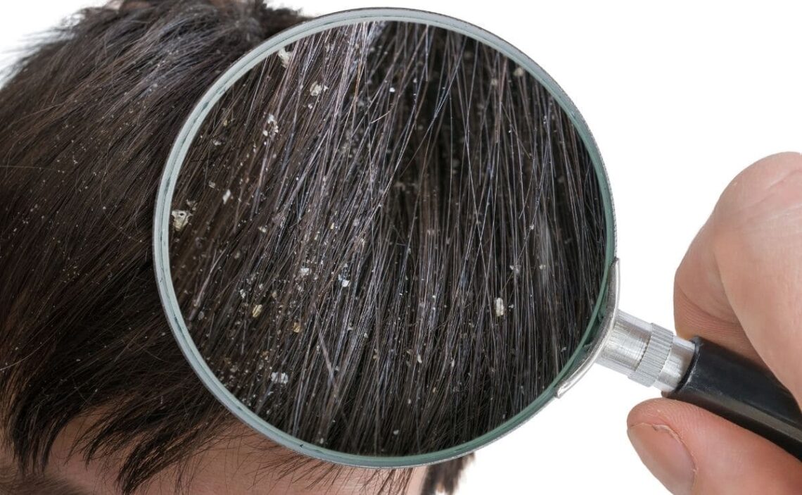 consejos eliminar caspa raiz