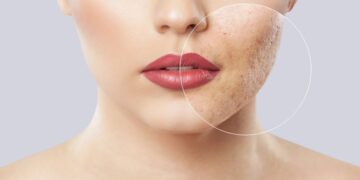 consejos mejorar acne facial