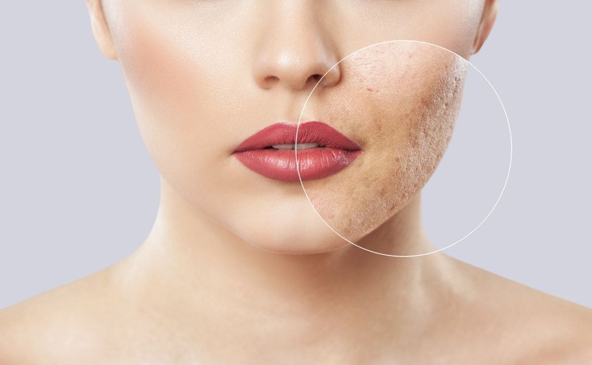 consejos mejorar acne facial