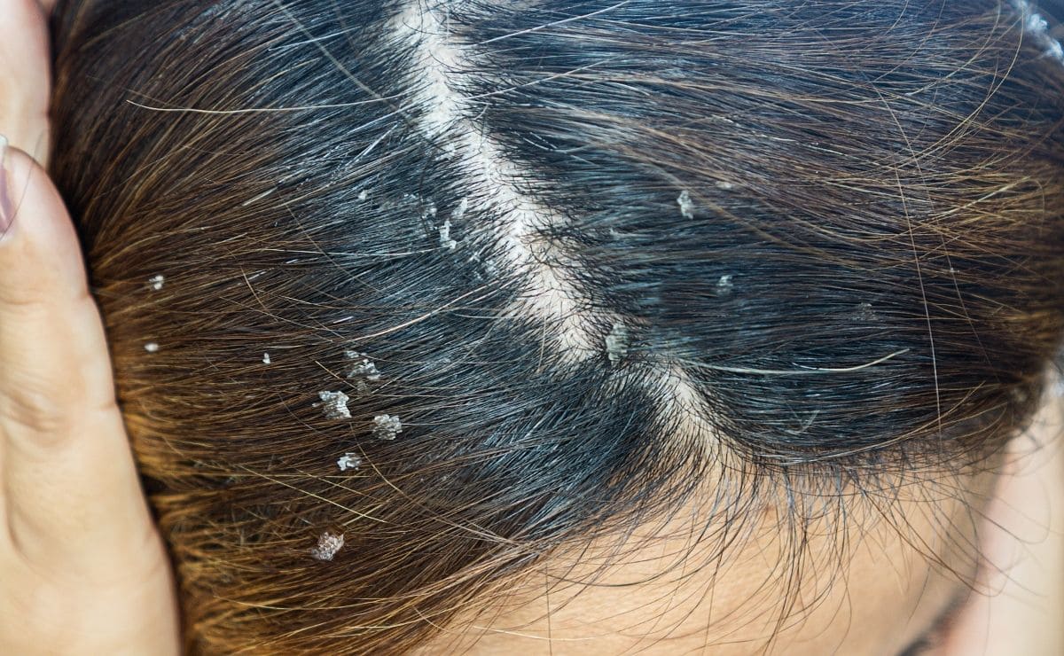 consejos prevenir caspa cabello pelo