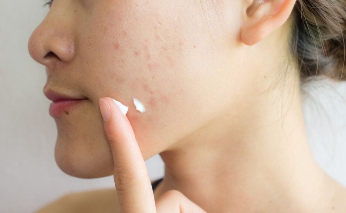 eliminar acne piel