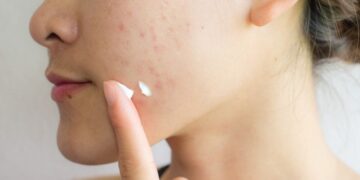 eliminar acne piel