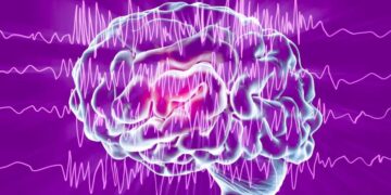 epilepsia cerebro