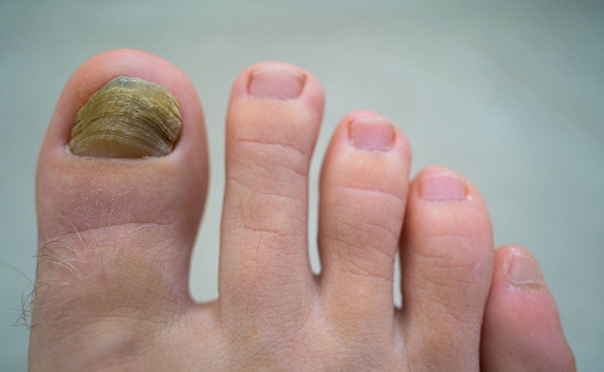 hongo uña bicarbonato de sodio