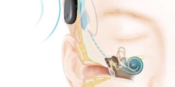 Imagen de implante coclear en la parte posterior del oído.