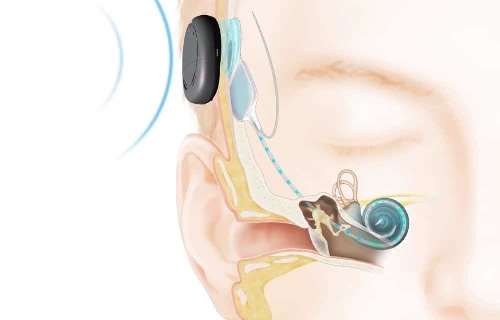 Imagen de implante coclear en la parte posterior del oído.