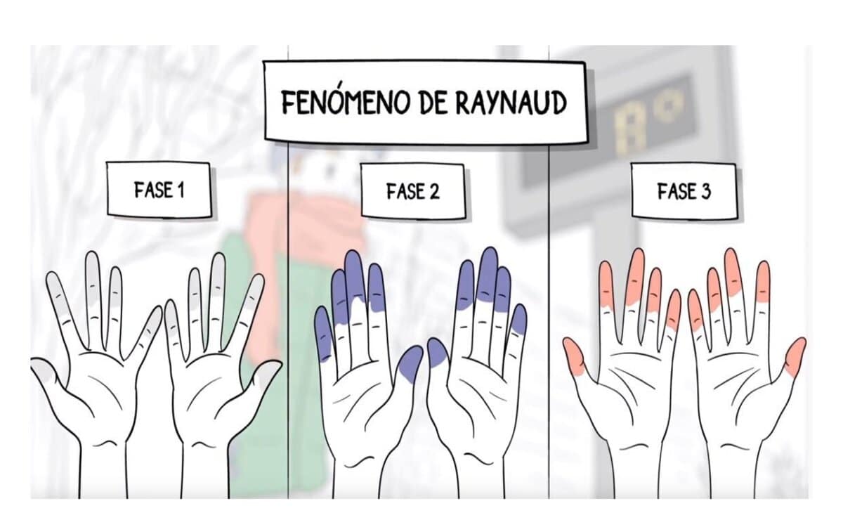 el fenómeno de raynaud afecta la piel