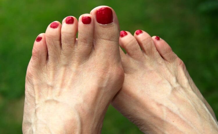 juanetes dolor pies organismo remedio casero natural