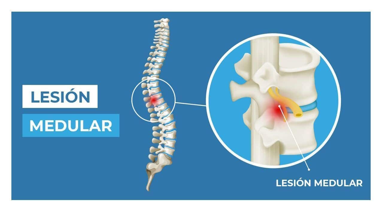 lesion medular columna vertebral