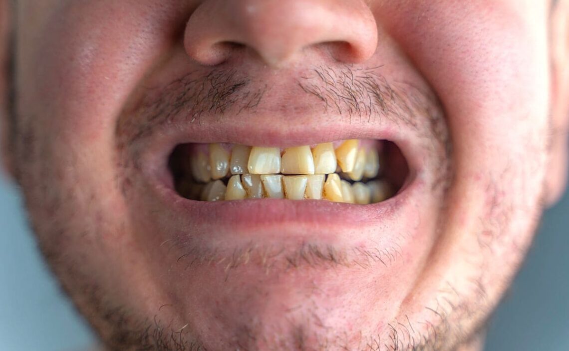 Trucos para eliminar las manchas marrones de los dientes