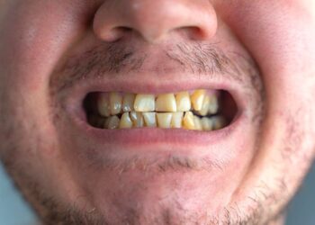 Trucos para eliminar las manchas marrones de los dientes