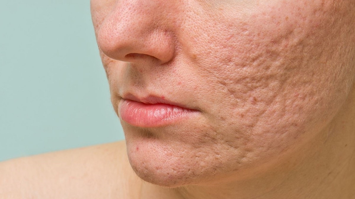 Activos para eliminar las marcas ocasionadas por el acné