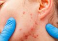miliaria acne verano calor