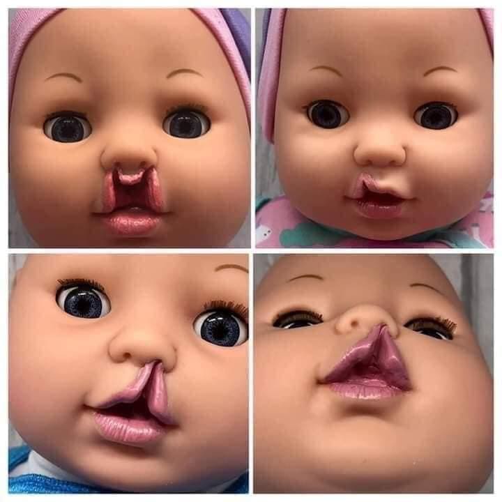 Fabrican muñecos inclusivos con audífonos, labio leporino o cicatrices de cirugía cardíaca
