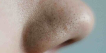 5 consejos para eliminar los puntos negros y la grasa de la nariz