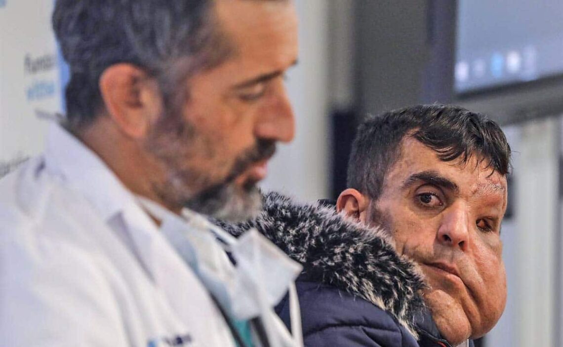 Ali, el joven al que Pedro Cavadas le ha extirpado una tumoración gigante en la cara: "Soy otra persona, ahora tengo vida"