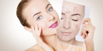 Los parches para eliminar los granitos que aparecen a causa del acné son uno de los remedios más usados por las personas que lo sufren