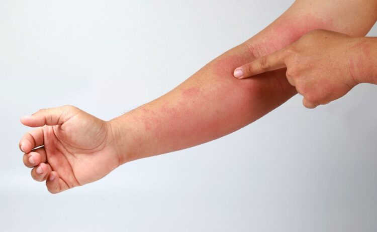 Persona con esclerodermia señala las manchas en la piel
