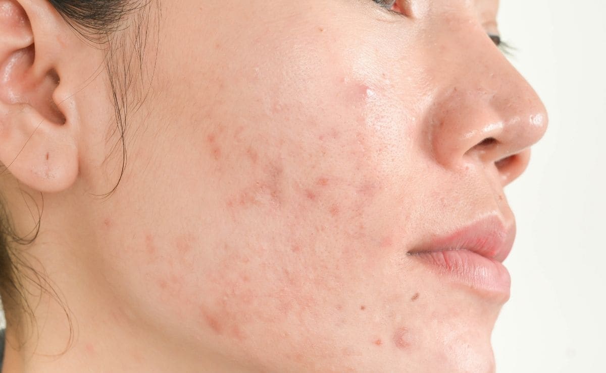 Rutina facial para personas con piel acneica