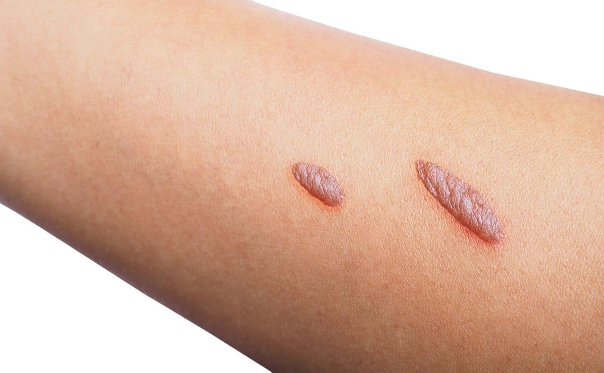 Síntomas y medidas de prevención de la piel de mariposa