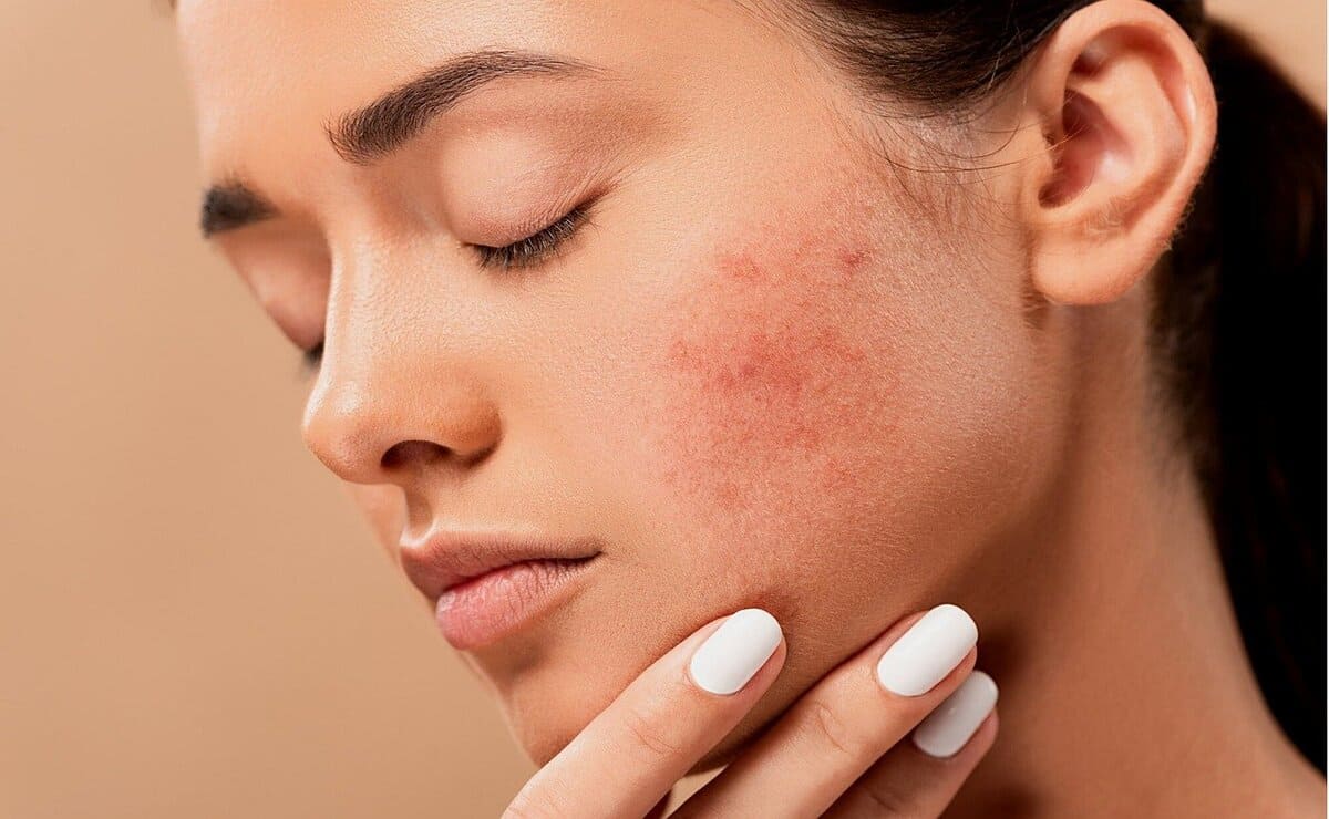 El carbón activado erradica el acné de la piel